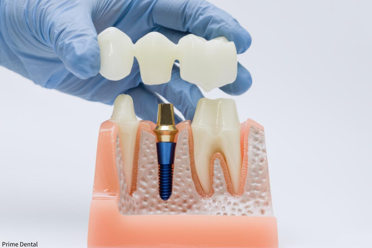 dental crowns Coquitlam