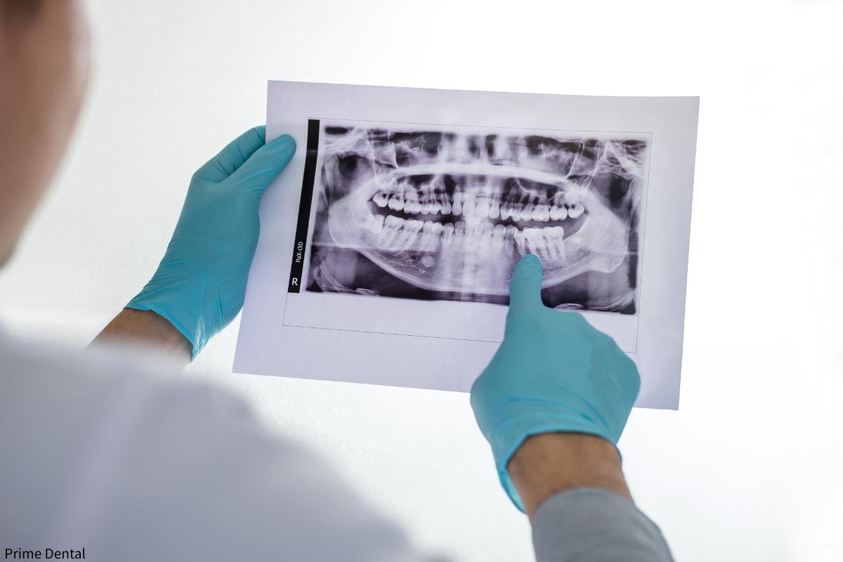 dental x-rays Coquitlam