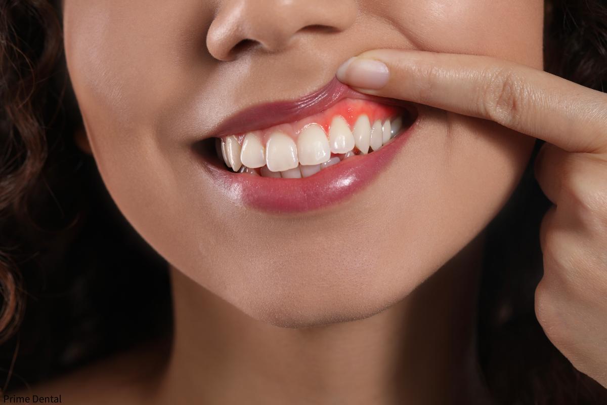 mouth breathing oral health Coquitlam