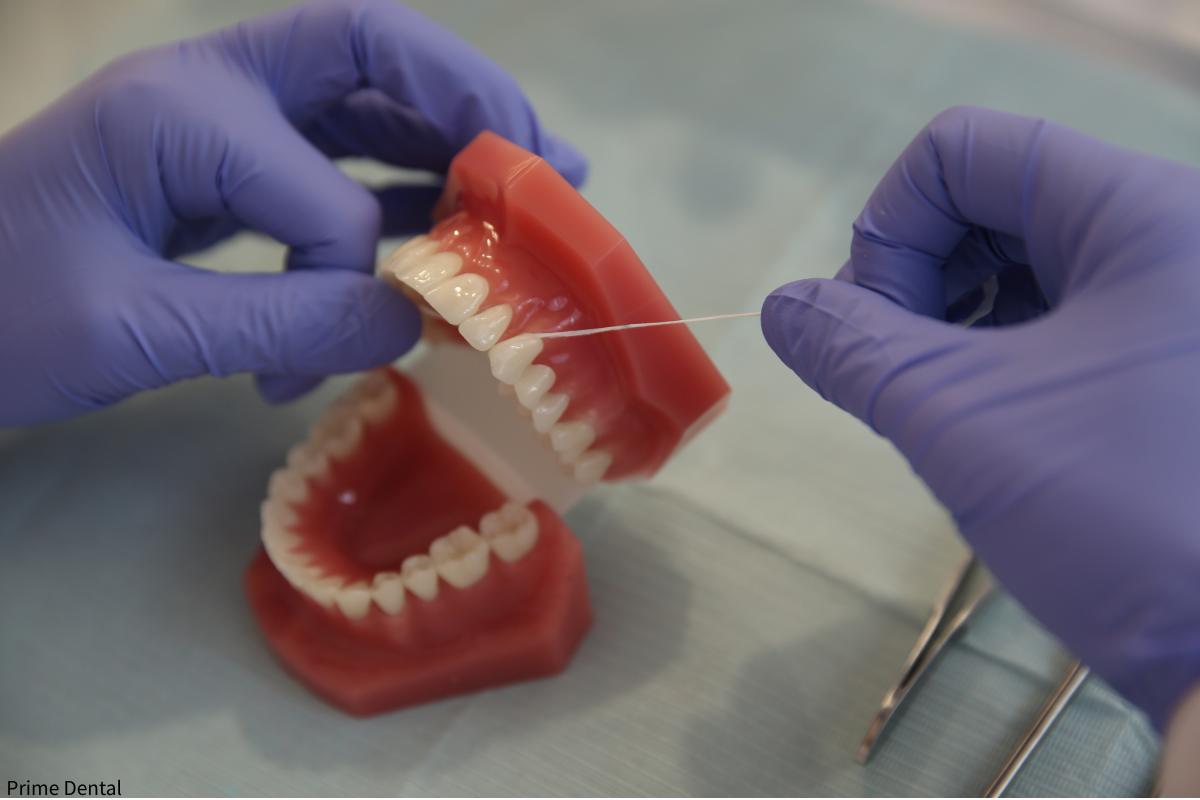food stuck between teeth Coquitlam