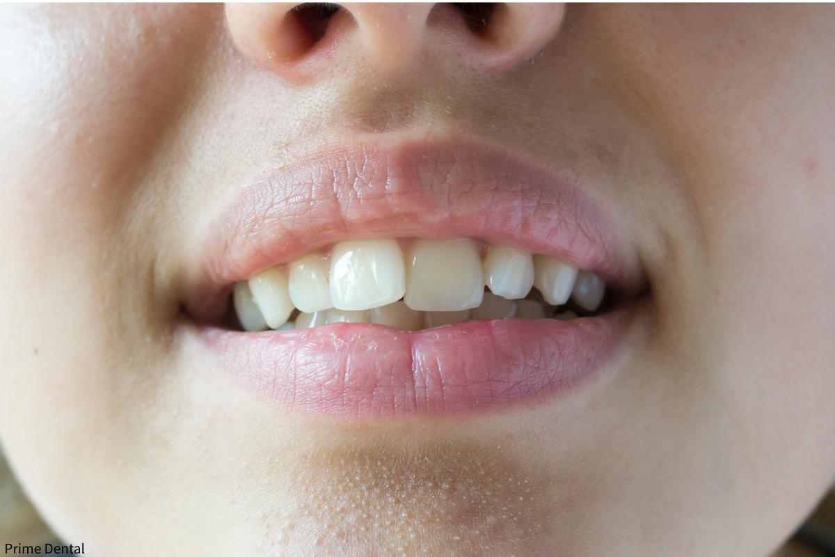 crooked teeth oral health Coquitlam