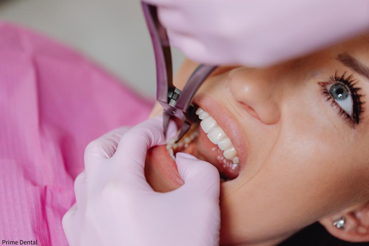 dental filling replacement Coquitlam