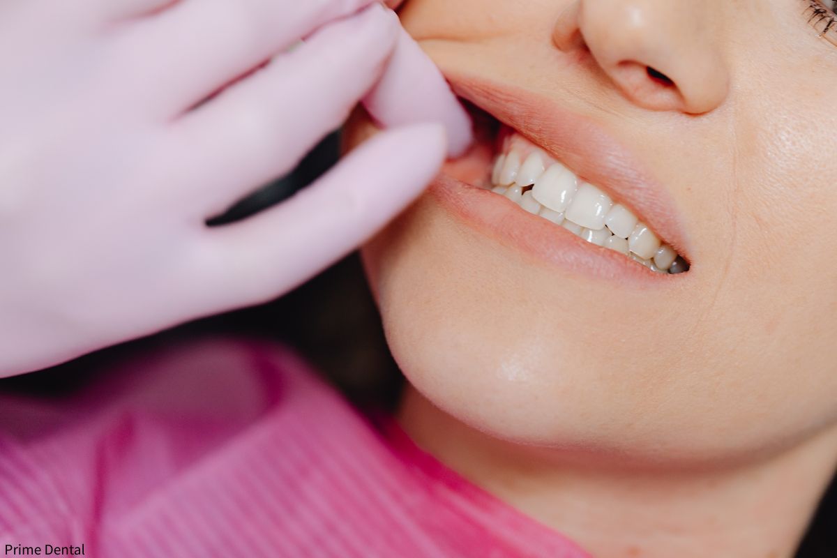 dark spot on tooth Coquitlam