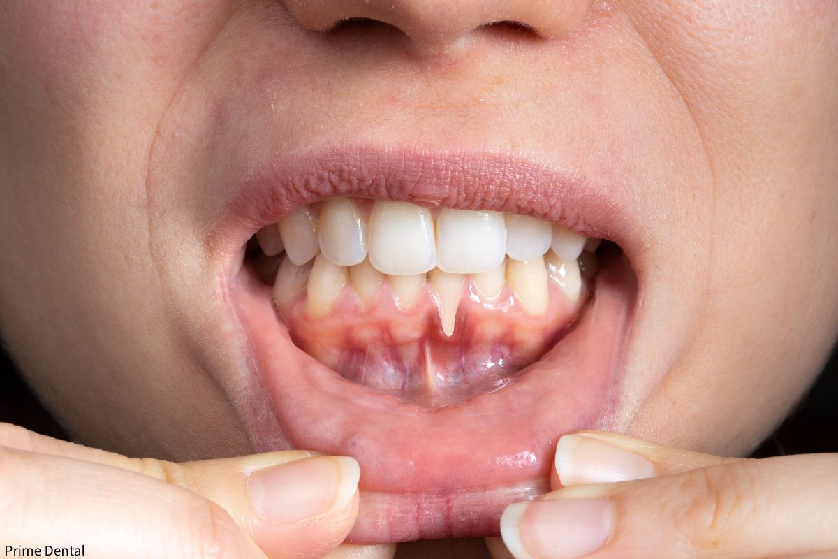 receding gums Coquitlam