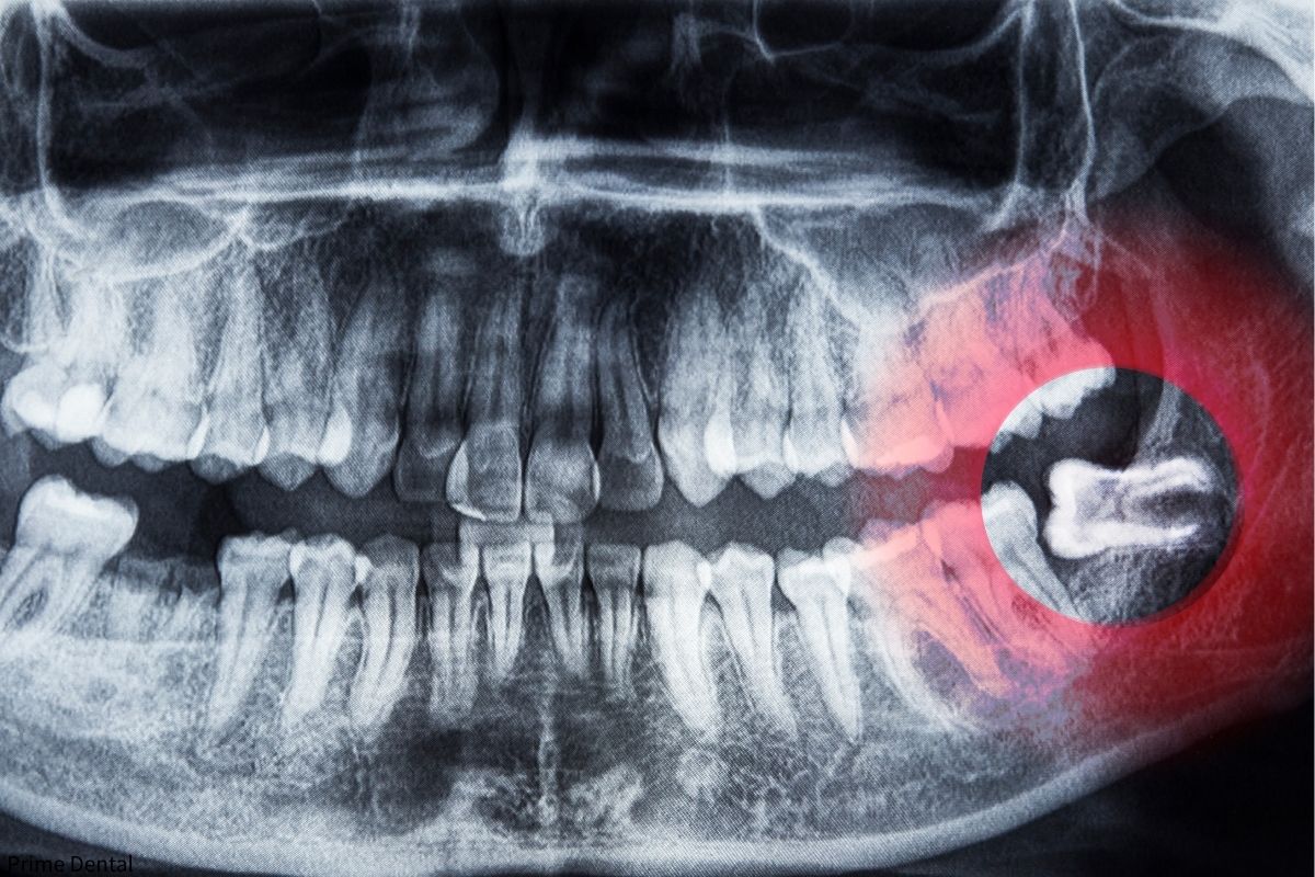 wisdom teeth Coquitlam