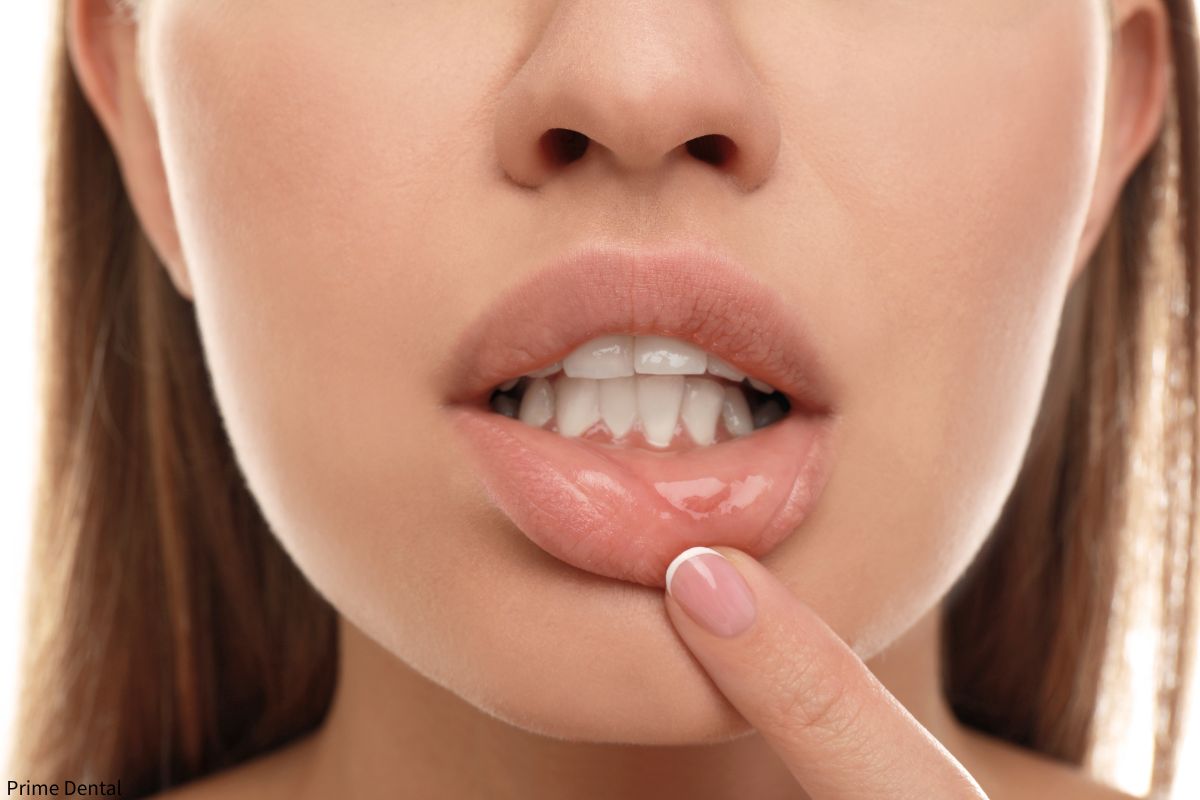 canker sores Coquitlam