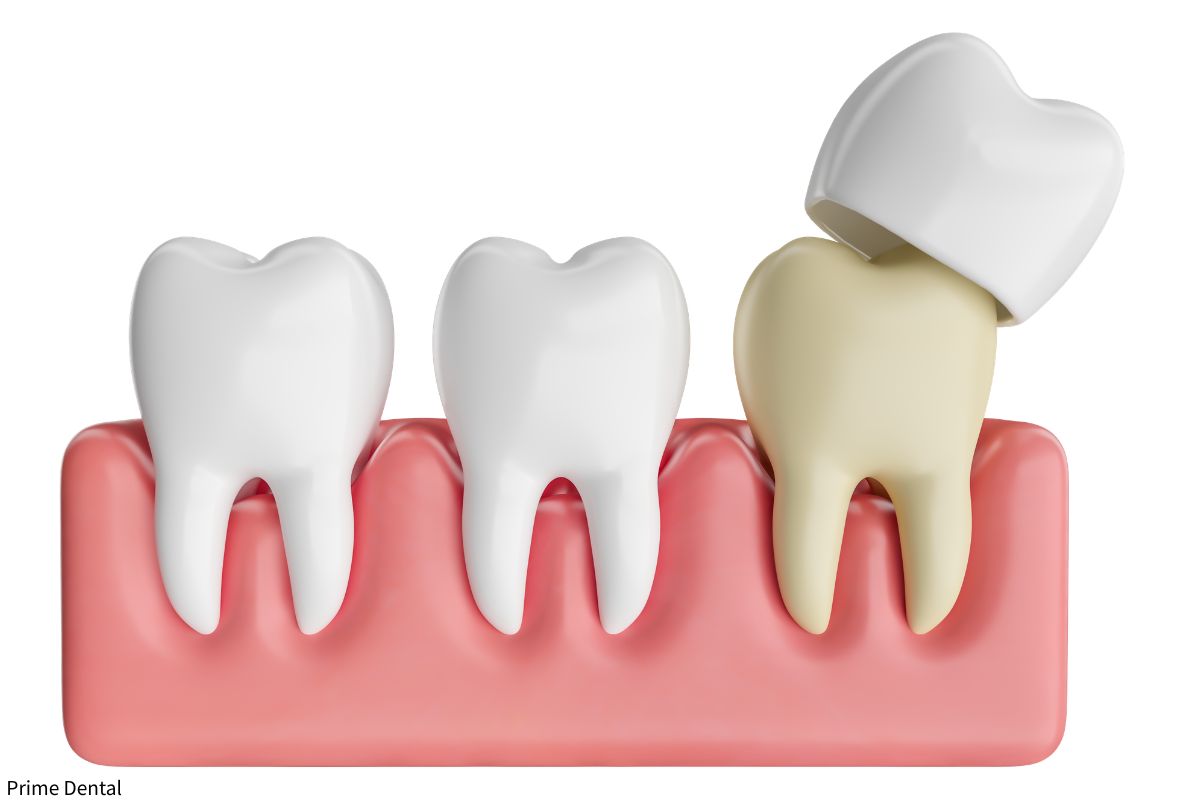 dental crowns Coquitlam